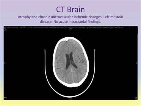 PPT - Hepatic Encephalopathy… Maybe? PowerPoint Presentation, free ...