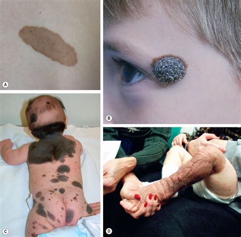 Congenital melanocytic nevi - Clinical Tree