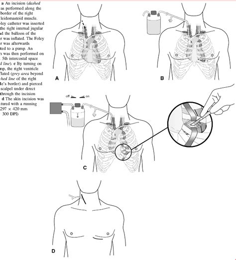 Image result for Thoracotomy Procedure Clamshell