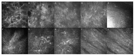 Corneal Artificial Endothelial Layer (EndoArt): Literature Review and ...