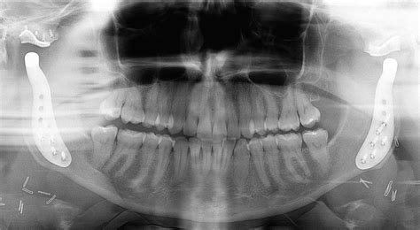 First Bite Syndrome After Bilateral Temporomandibular Joint Replacement ...