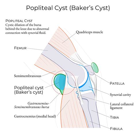 Clinical Medicine Glossary: Popliteal cyst (Baker's Cyst) | ditki medical & biological sciences