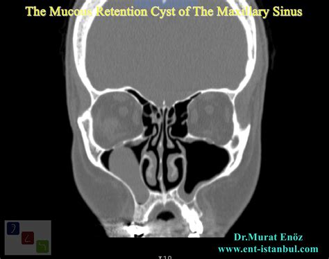 Health Zone Turkey: In Which Situations Is Paranasal Sinus Tomography Required Before The Nasal ...