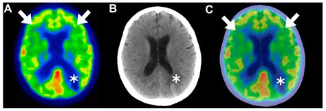FDG-PET in Chimeric Antigen Receptor T-Cell (CAR T-Cell) Therapy ...