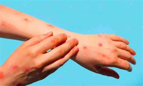టమోటో ఫ్లూ టెన్షన్..! | What is Tomato Flu and should you be worried ...