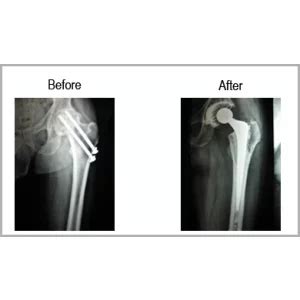 AVN After Neck Femur Fracture - Dr Samir Nanavati