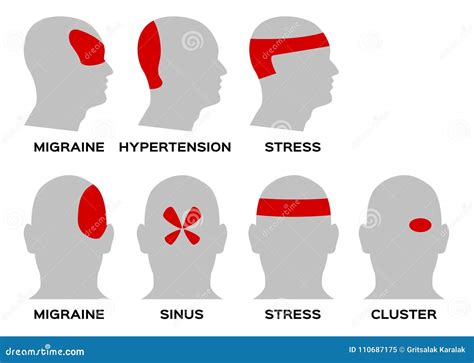 Tipo Del Dolor De Cabeza/concepto Del órgano Y De La Anatomía Ilustración del Vector ...