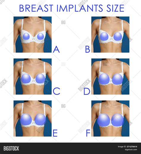 Size C Breast Implants
