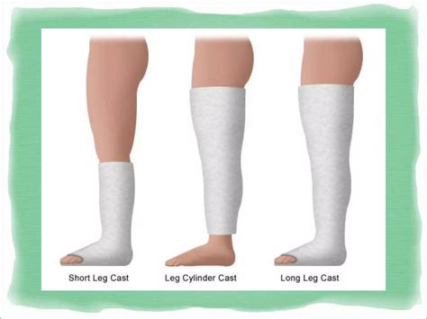 Casting and splinting | PPT