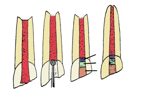 Image result for Pulp Extraction Tooth