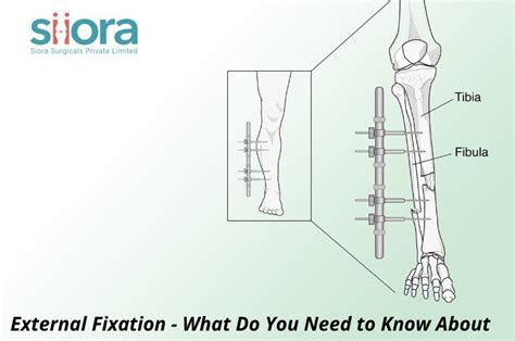 Image result for External Fixation Explained
