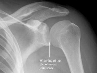 Image result for Sulcus Sign Shoulder Dislocation