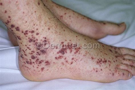 My feet and ankles are swollen with red small blood-like rash above my ...