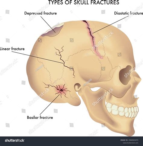 Medical Illustration Types Skull Fractures Annotations Stock Vector (Royalty Free) 2582922473 ...