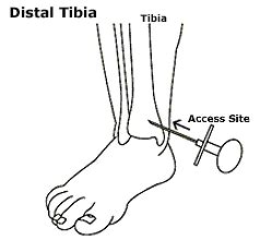 Image result for Intraosseous Access Procedure