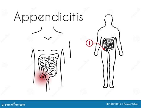 Image result for Appendix Inflammation