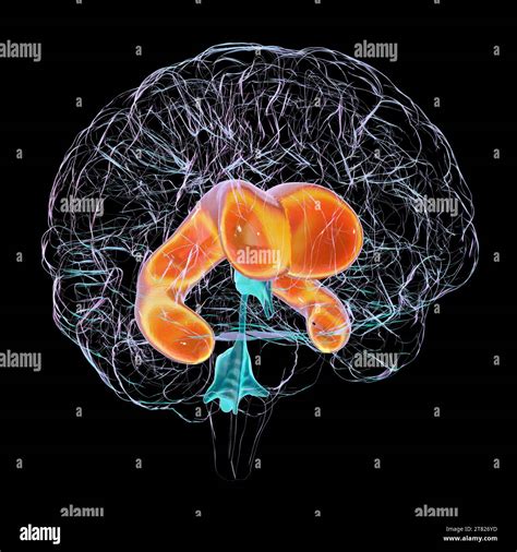 Enlarged lateral ventricles of the brain, illustration Stock Photo - Alamy