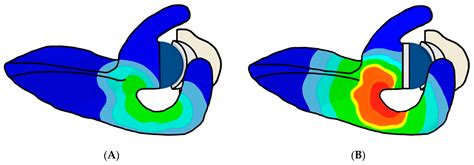 Factors Influencing Acromial and Scapular Spine Strain after Reverse ...