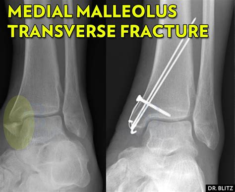 5 Kinds of Medial Malleolus Ankle Fractures