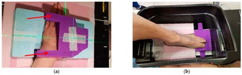Clinical Application of a Customized 3D-Printed Bolus in Radiation ...