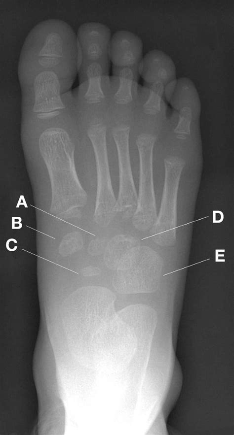 Radiograph of a 3 year old child’s right foot | The BMJ