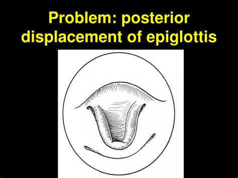 PPT - Congenital Larynx Lesions & Stridor Evaluation PowerPoint ...