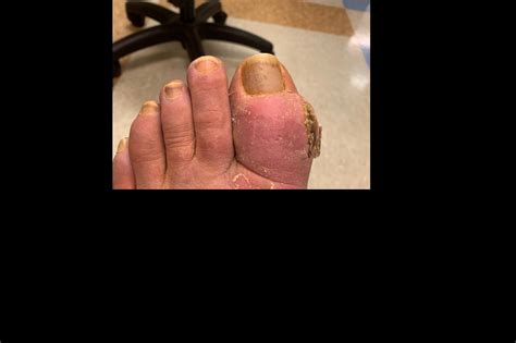 Big Toe Inflammation