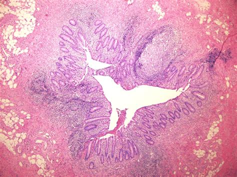 Image result for Normal Appendix Real