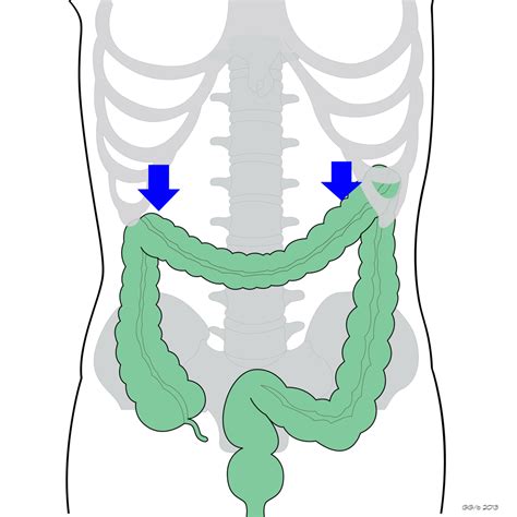 Splenic Flexure Location Colon Adenocarcinoma Splenic Flexure