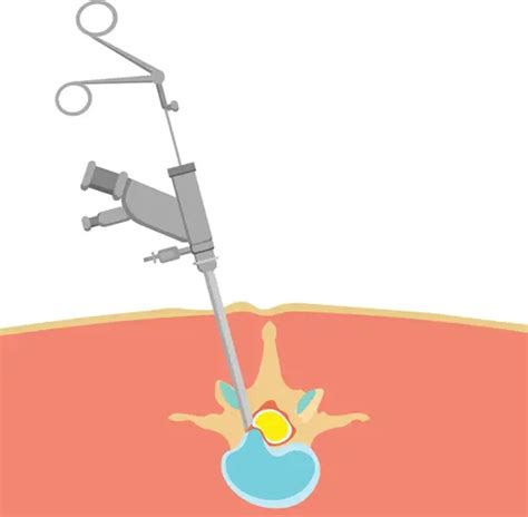 Minimally Invasive Epidural Neuroplasty