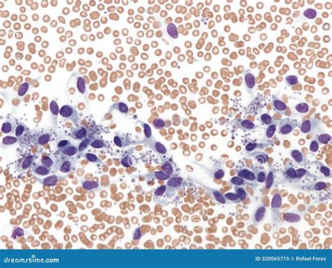 Endothelial Cells in a Peripheral Blood Smear. Stock Image - Image of inside, endothelial: 320065715