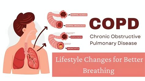 COPD Management: Breathe Easier with Lifestyle Changes