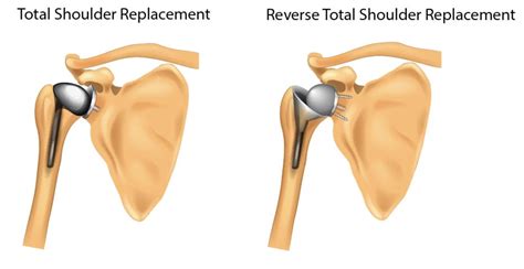 Reverse Total Shoulder Replacement — Adam B. Cohen, MD
