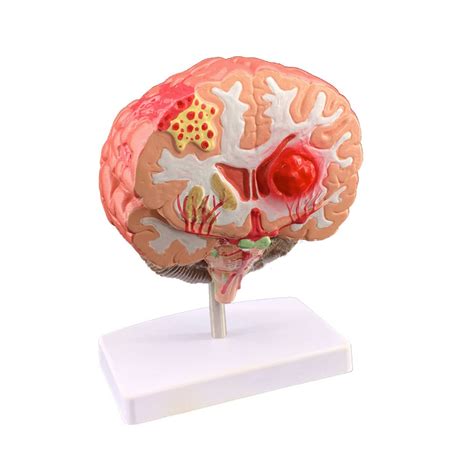 Buy Simulation of Human Brain Disease Model Brain Anatomy Neurosurgery ...