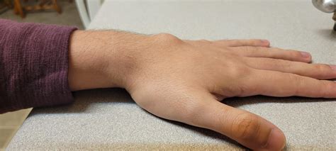 Ganglion cyst. Surgery pictures included : r/popping