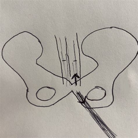 How Physical Therapy Treats Athletic Pubalgia/Sports Hernias