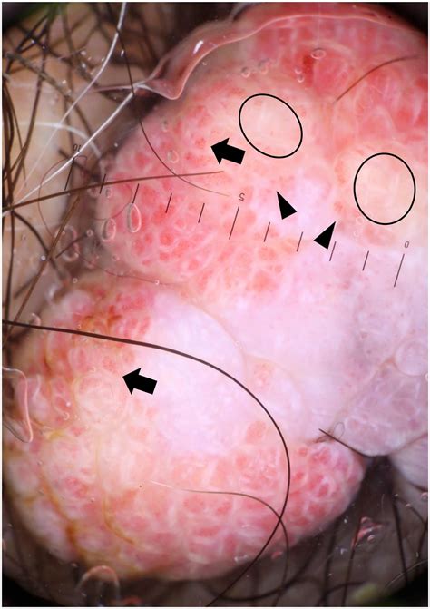 Red nodule on the scrotum - JAAD Case Reports