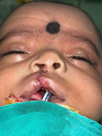 Dr. Subhasis Saha - Expert in Pediatric Plastic Surgery - India ...