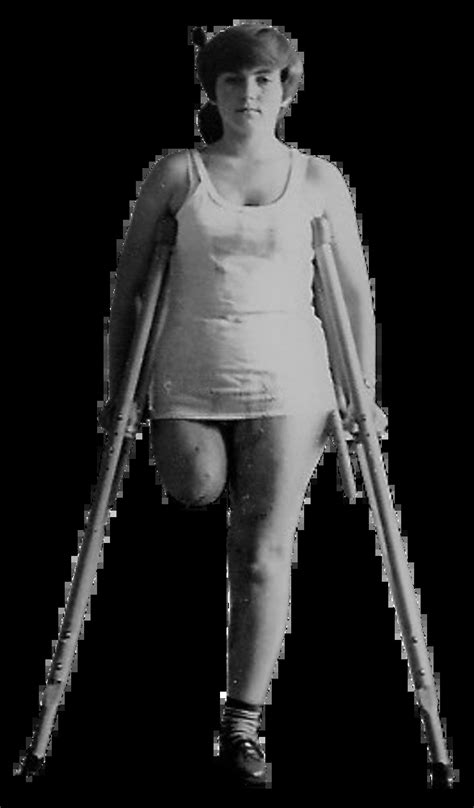 Comprehensive Guide on Above Knee Amputation