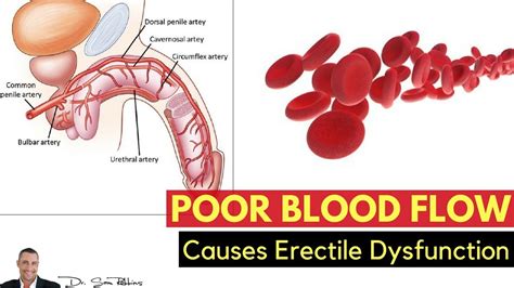 Image result for Ed Blood Flow Problems