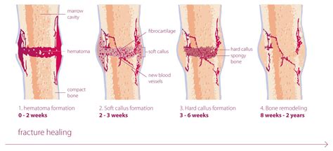 Image result for Bone Healing Process