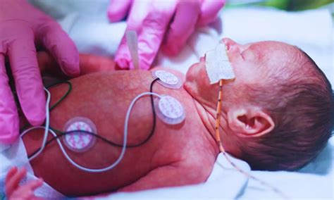 Betamethasone Retreatment Restores Benefits for Severe Intraventricular ...