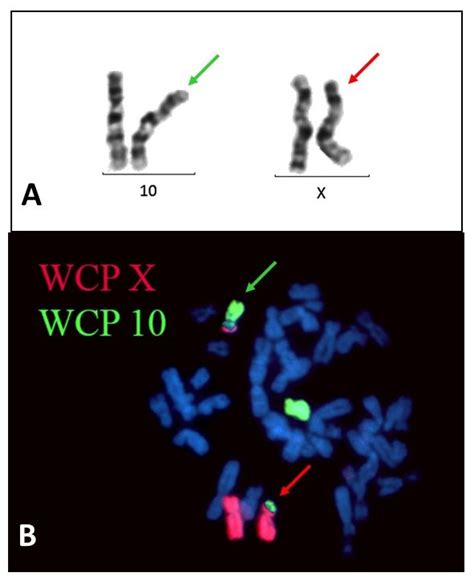 An Ultra-Rare Manifestation of an X-Linked Recessive Disorder: Duchenne ...