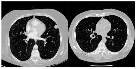 Transformer-Based Recognition Model for Ground-Glass Nodules from the ...