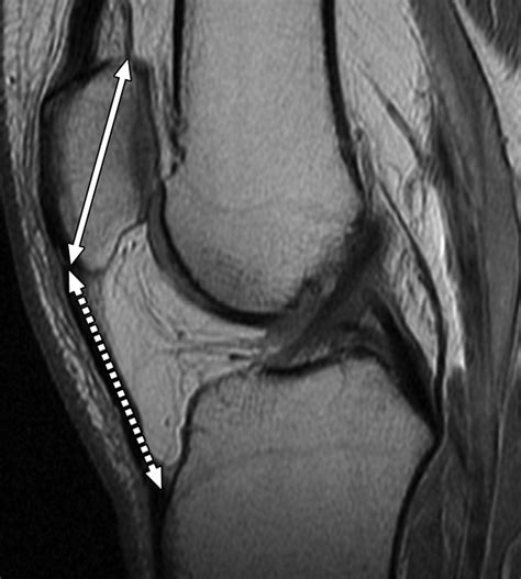 Superolateral Hoffa's Fat Pad Edema: Association With Patellofemoral ...