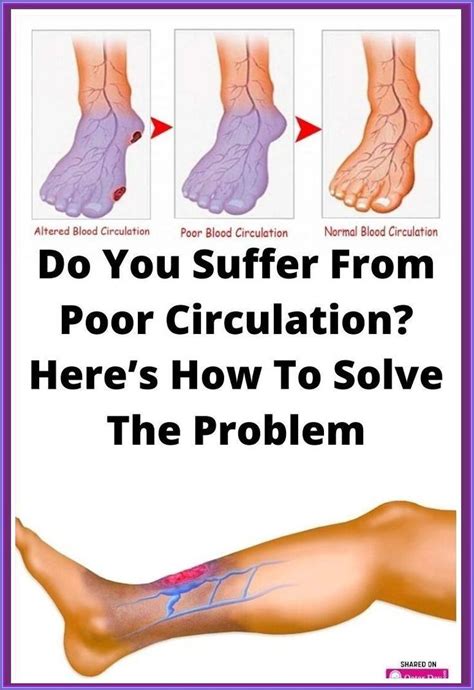 Image result for Leg Circulation Problems Symptoms