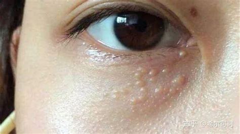 如何去除眼部脂肪粒，正确的使用眼霜可以帮到你_伊秀视频|yxlady.com