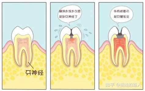 晚上如何缓解牙髓炎疼痛 8个妙招快速解决牙痛问题_牙髓炎_快速问医生