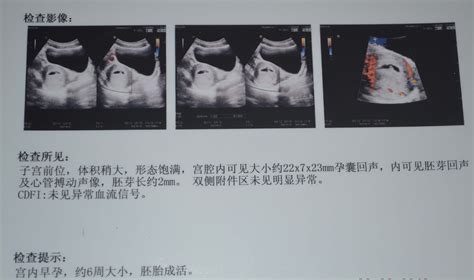妇科医师有没有，我想知道，就凭这张B超图，在不了解月经的情况 能不能看出大概受孕多久 - 百度宝宝知道