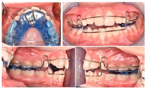 Pediatric Treatment of Anterior-Upper-Single Dental Crossbite Using a ...